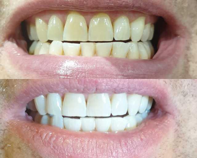 Teeth Whitening Strips - 14 treatments